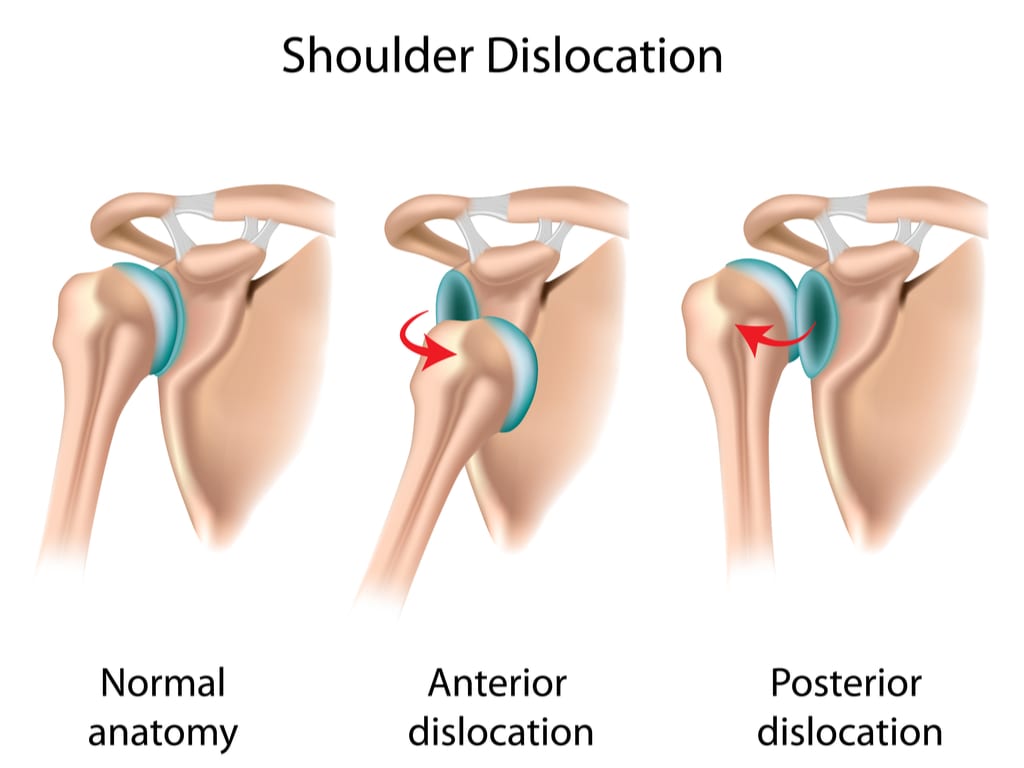 shoulder dislocation compared with its normal stage