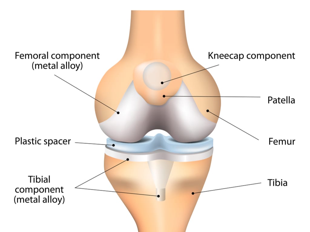 knee joint replacement explanation
