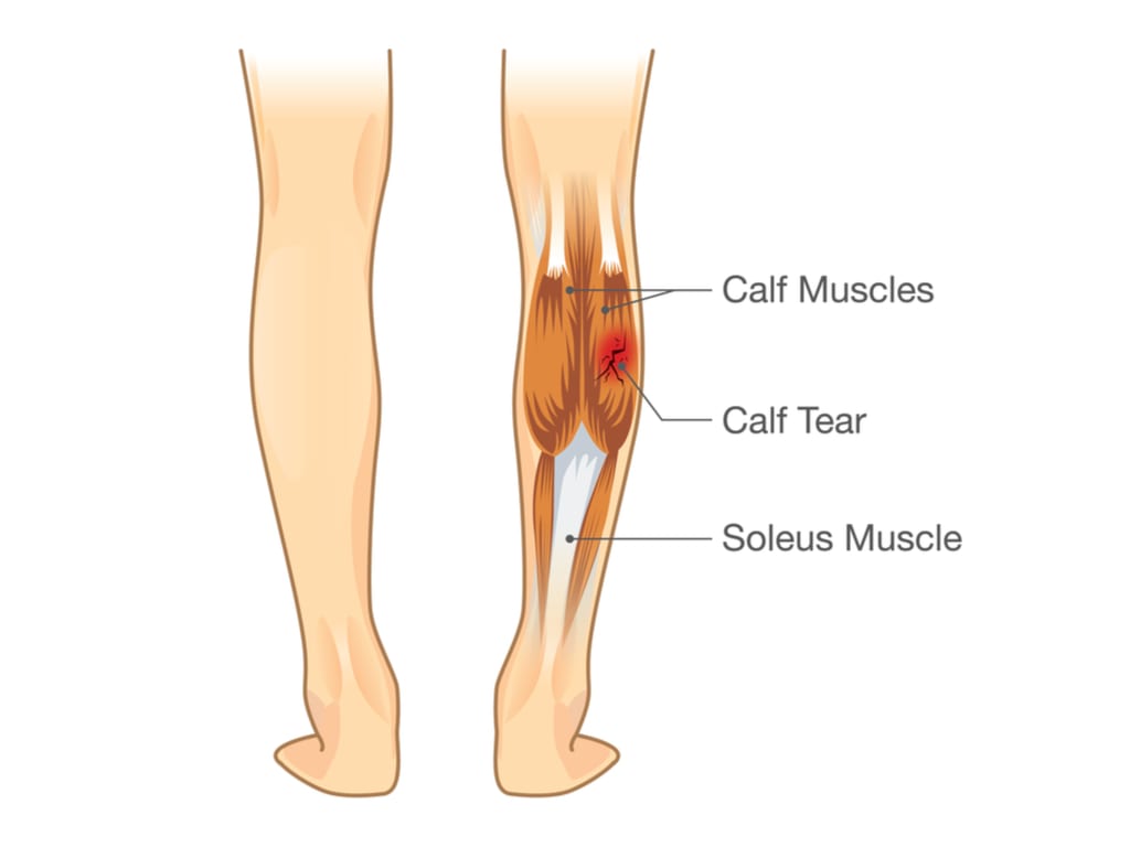 Endurocad - Injury Focus- Calf Strain A calf strain is an injury to the  muscles in the calf area (the back of the lower leg below the knee). The calf  muscle is