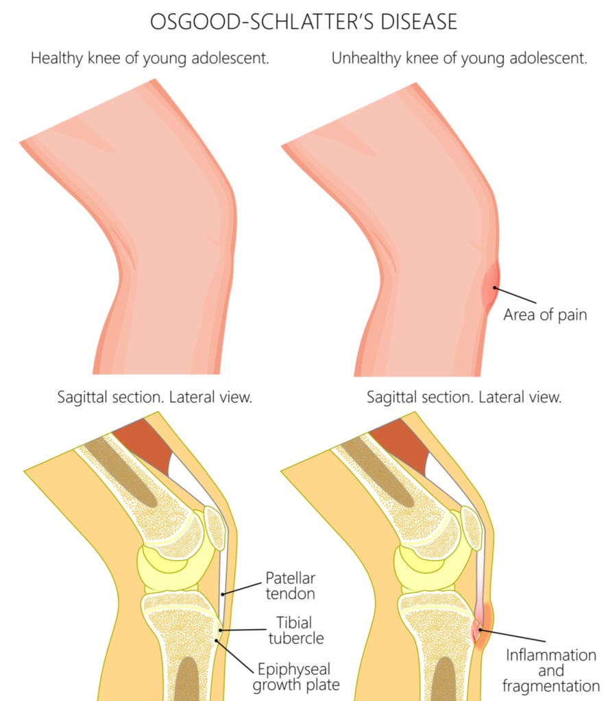 Osgood Schlatters Disease Dynamic Physio